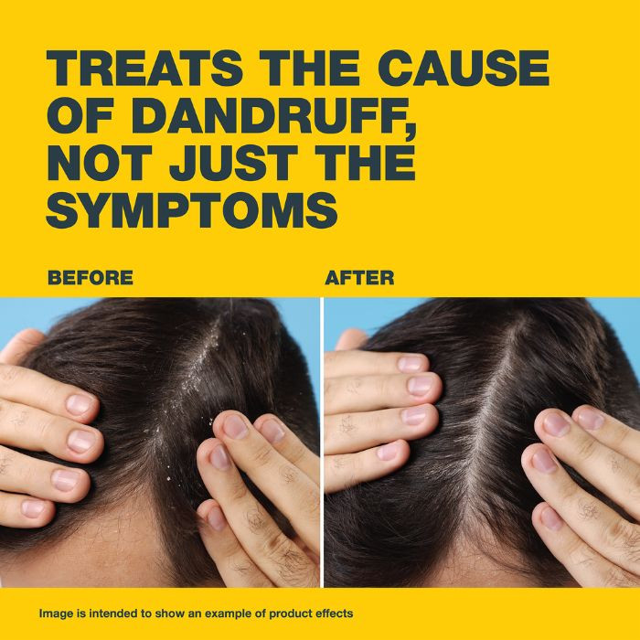 Nizoral Anti Dandruff Shampoo 100ml