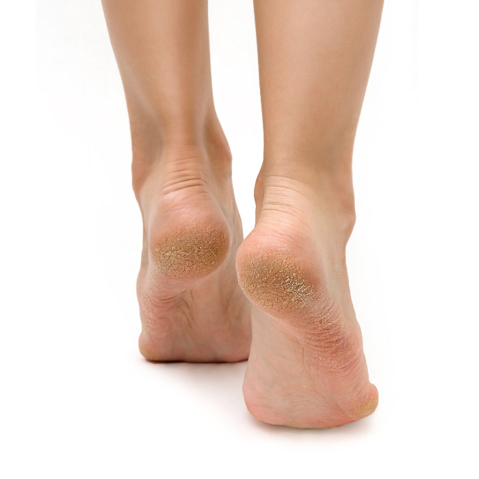 Feetcalm Callus & Hard Skin 20% Urea Spray 75ml