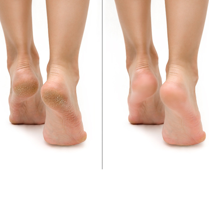 Feetcalm Callus & Hard Skin 20% Urea Spray 75ml