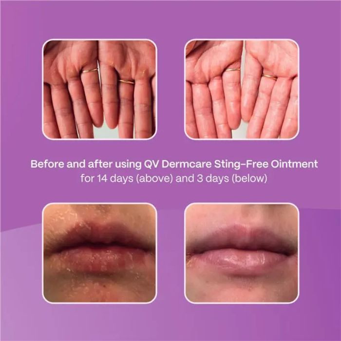 Ego QV Dermcare Sting-Free Ointment with Ceramides, Supports Skin Barrier, Hydrating and Soothing, 200g