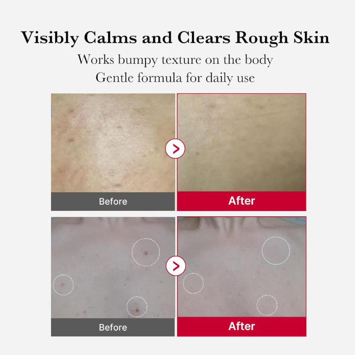 Medicube Red Acne Body Peeling Shot, AHA BHA PHA LHA Exfoliant Spray for Breakouts, 110g